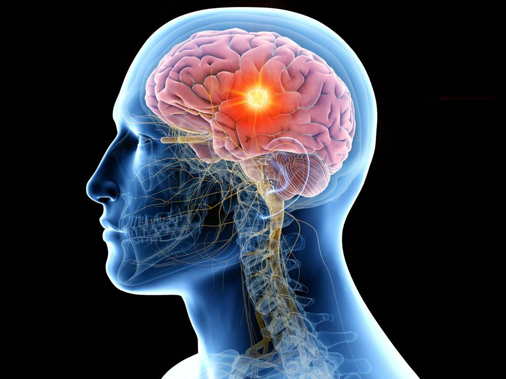Tìm ra phương pháp điều trị u não thông qua mô hình khối u 3D