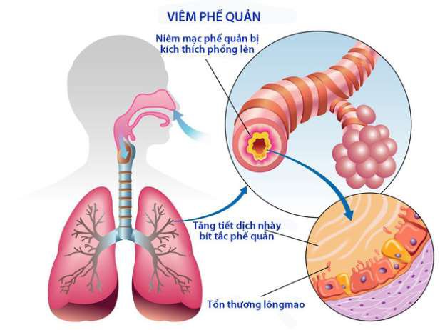 Các triệu chứng của viêm phổi ở người lớn