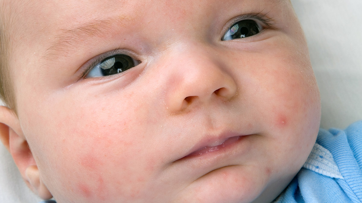 Những dấu hiệu nhận biết bệnh tràm để bố mẹ có thể phòng ngừa cho trẻ