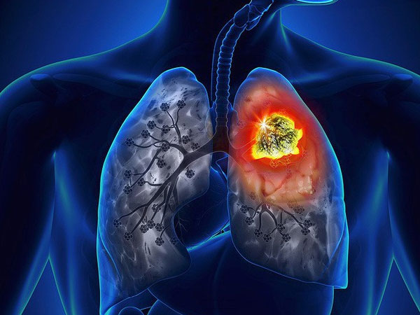 Cách phòng ngừa viêm phổi cho người lớn